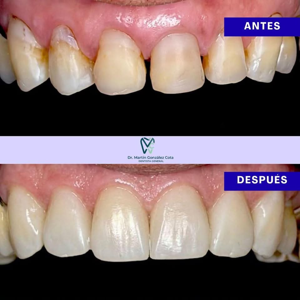 Dientes anteriores antes y después del retiro de caries y obturación con resina.