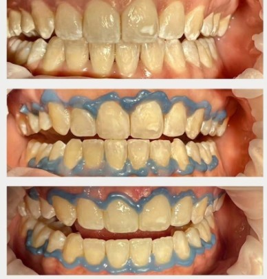 Tres fotografías de dientes anteriores durante microabrasión dental, con barrera azul.